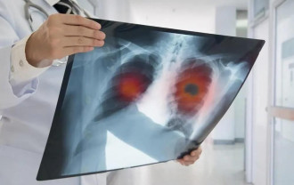 Cancerul pulmonar face ravagii, o treime din pacienţi, nefumători - Avalanşă de cazuri